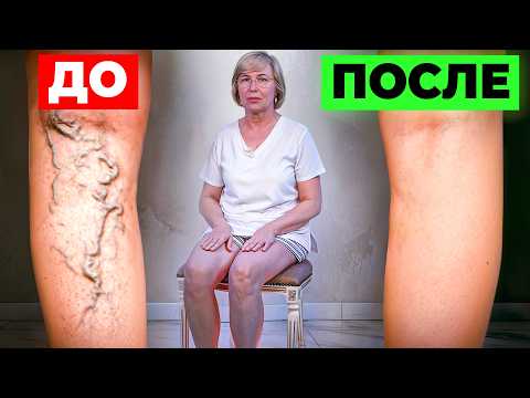 Видео: ПОКАЖУ КАК БЫСТРО ИЗБАВИТЬСЯ ОТ ВАРИКОЗА 1 УПРАЖНЕНИЕМ