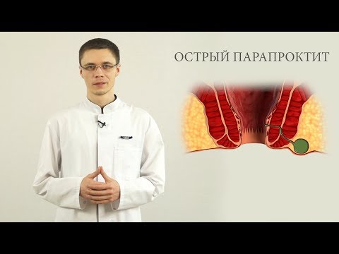 Видео: острый парапроктит лечение, диагностика