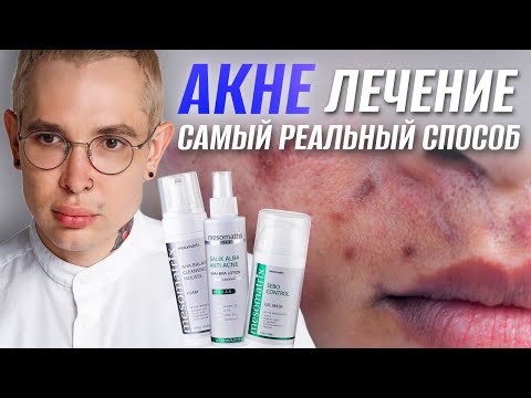 Видео: АКНЕ ЛЕЧЕНИЕ | самый реальный способ вылечить #акне НАВСЕГДА #роаккутан