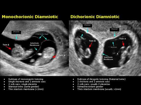 Видео: УЗИ близнецов: норма или патология | Монохориальное/Дихориальное/Диамниотическое/Моноамниотическо...
