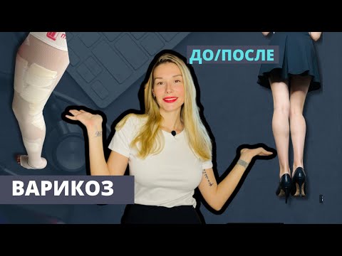 Видео: ВАРИКОЗНОЕ РАСШИРЕНИЕ ВЕН. КАК ЭТО УБРАТЬ? СКОЛЬКО СТОИТ. СКЛЕРОТЕРАПИЯ И ЛАЗЕР.