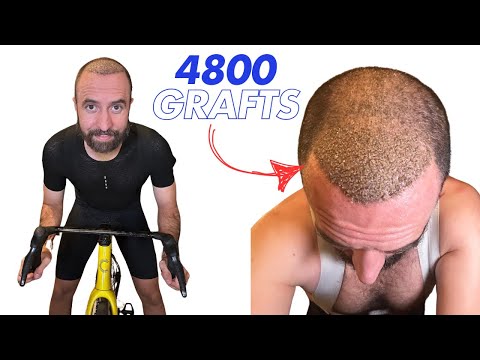 Видео: Я сделала пересадку волос в Турции! (ЖЕСТОКАЯ честность)