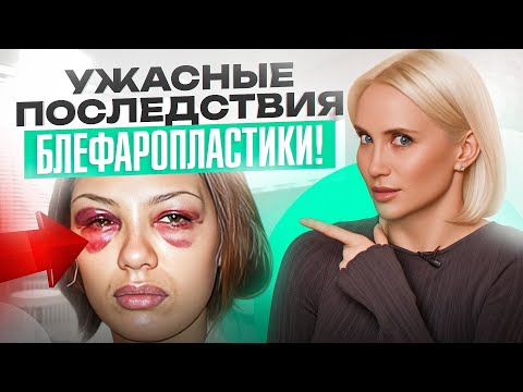 Видео: Блефаропластика от горе-хирургов, которая вас шокирует! ПОСЛЕДСТВИЯ