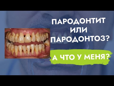 Видео: Пародонтит или пародонтоз? В чем различия?