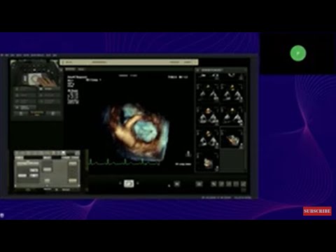 Видео: Проведение 3D эхокардиографии на ультразвуковых аппаратах Philips
