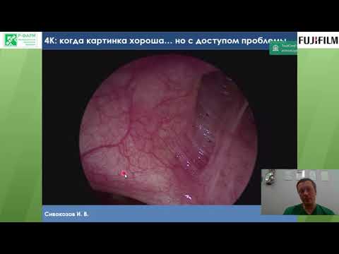 Видео: Современные возможности респираторной эндоскопии. И. В. Сивокозов