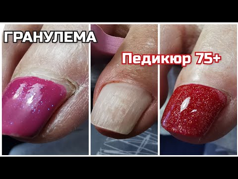 Видео: 75➕ГРАНУЛЕМА:последствия😍ВОЗРАСТНОЙ ПЕДИКЮР🙈толстые ногти😉что стало с ПРИЛИПШЕЙ КУТИКУЛОЙ❤️