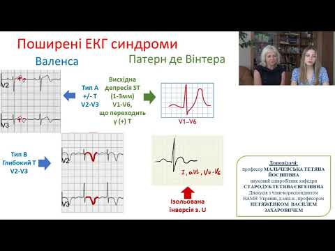 Видео: Гострий коронарний синдром без елевації ST: сучасні рекомендації з діагностики та лікування