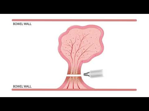 Видео: Курс по эндоскопии – Электрохирургия 5. Горячая петля