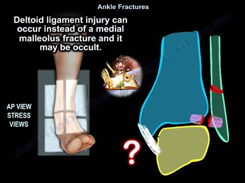 Видео: Переломы лодыжки — всё, что вам нужно знать — доктор Набиль Эбрахайм