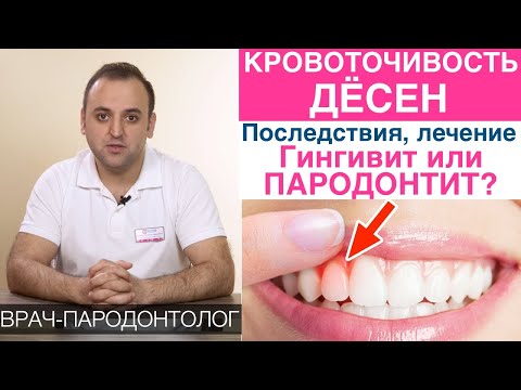 Видео: Кровоточивость десен - причины, последствия, лечение! Гингивит и пародонтит - что делать?