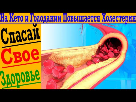 Видео: Холестерин повышается на Кето Диете! Как уберечь себя от инфарктов, инсультов и атеросклероза!