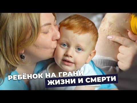 Видео: НЕВУС С УЗЛАМИ ГИБРИДНОЙ ОПУХОЛИ | История Максима Мирзоева