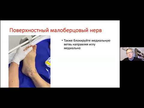 Видео: Блокада нервов на уровне лодыжек/стопы