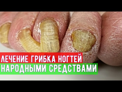 Видео: Грибок народное лечение от врача дерматолога