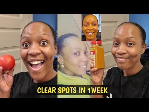 Видео: У ВАС НИКОГДА НЕ БУДЕТ ЧЕРНЫХ ТОЧЕК, АКНЕ И ПРЫЩЕЙ ПОСЛЕ ИСПОЛЬЗОВАНИЯ ЭТОГО СРЕДСТВА В ТЕЧЕНИЕ 1...