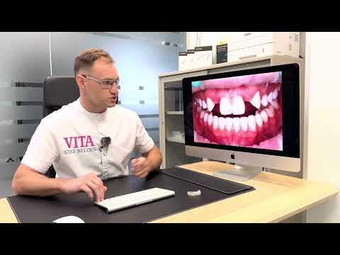 Видео: Элайнеры работают. Случай по коррекции прикуса элайнерам установке имплантов Стоматолог Стас Белоус