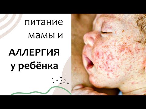 Видео: Питание мамы и АЛЛЕРГИЯ У РЕБЁНКА. Атопический дерматит. Выпуск 3