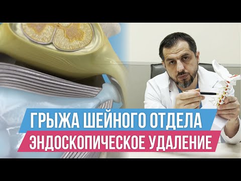 Видео: Грыжа шейного отдела позвоночника. Эндоскопическое удаление грыжи без установки имплантатов.
