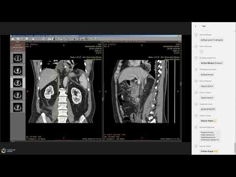 Видео: Техника написания заключений КТ  Острый и хронический панкреатит