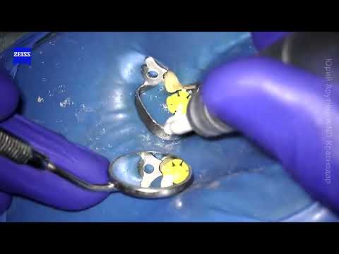 Видео: Извлечение штифта. Перелечивание. Закрытие перфорации. Установка СВШ