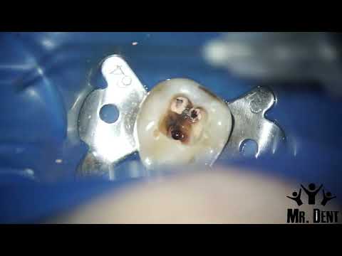 Видео: Распломбировка корневых каналов зуба , резорцин формалиновый зуб , эндодонтическое лечение| часть 1