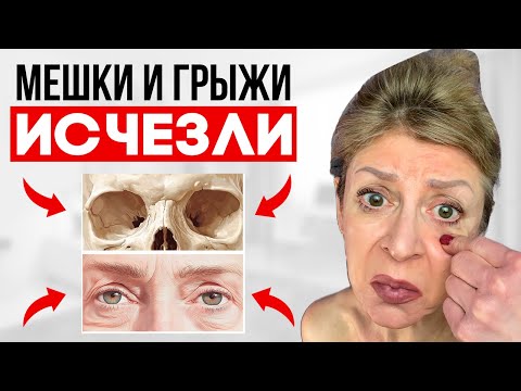 Видео: Это невероятно! Остеопатия уменьшает грыжи в 2 раза всего за 7 шагов!