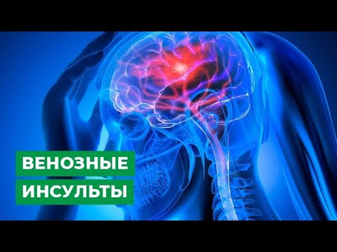 Видео: Венозные инсульты