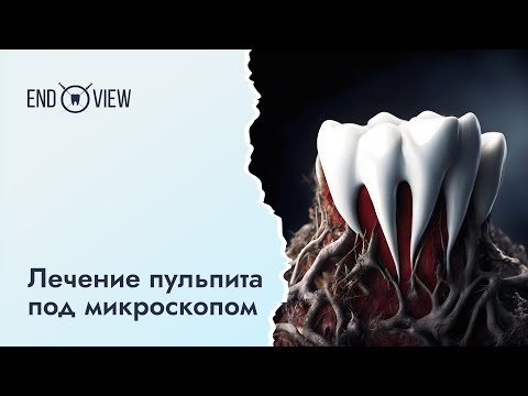 Видео: Пульпит – симптомы, боль и лечение под микроскопом