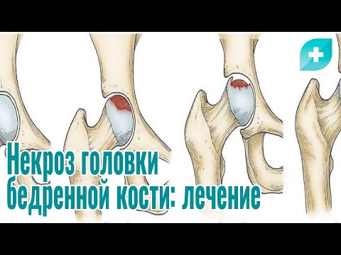 Видео: Некроз головки бедренной кости: лечение