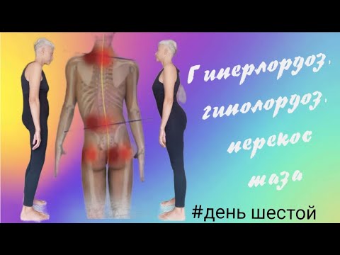 Видео: Гиперлордоз, гиполордоз, перекос таза, частые причины болей в пояснице. 