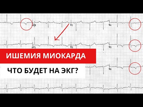 Видео: Нюансы ЭКГ диагностики ИБС (ишемической болезни сердца).