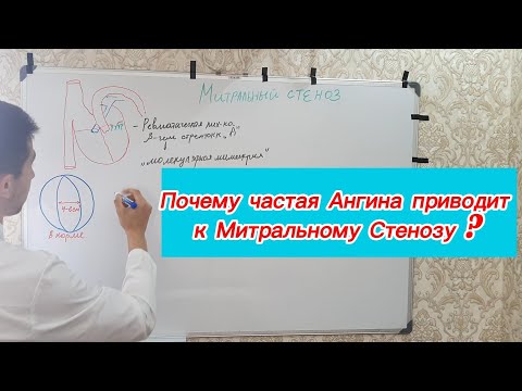 Видео: Частая Ангина приводит к Митральному стенозу ?
