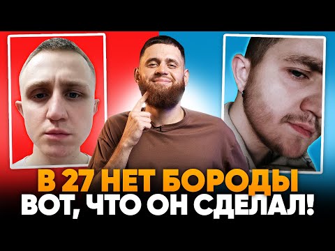 Видео: В 27 ЛЕТ не росла борода и В РОДУ все безбородые. Но помог ксиноксин!