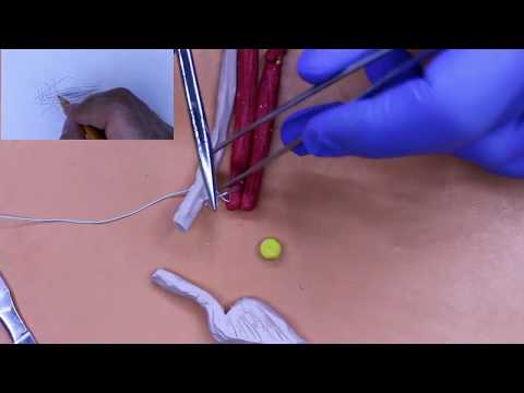 Видео: Пластика пахового канала по Кимбаровскому (Ахмадудинов А.М.)