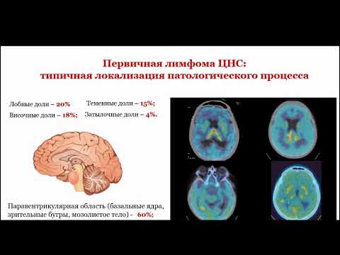 Видео: Рыжкова Д.В. «Клинический случай первичной лимфомы центральной нервной системы»