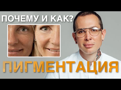Видео: ПИГМЕНТАЦИЯ НА ЛИЦЕ КАК ПРЕДОТВРАТИТЬ? Как избежать пигментных пятен #пигментация #пигментныепятна