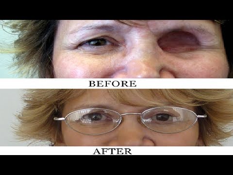 Видео: как это сделано Глазные протезы / восковые мелки