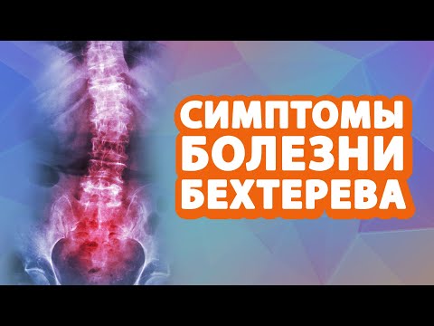 Видео: Симптомы болезни Бехтерева // Анкилозирующий спондилоартрит