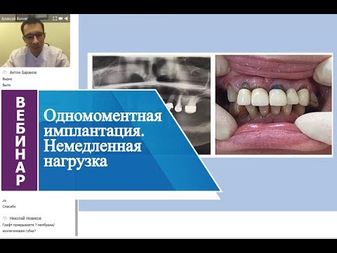 Видео: Вебинар "Одномоментная имплантация. Немедленная нагрузка".