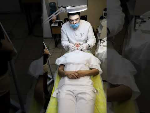 Видео: Фракционная мезотерапия