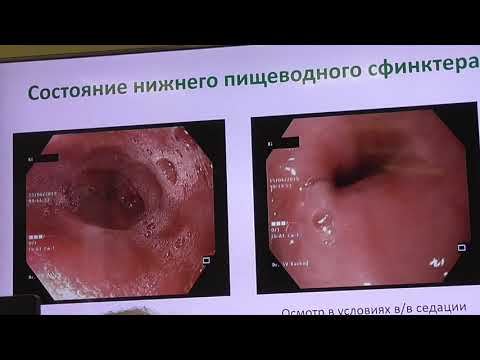 Видео: 06 Кайбышева ВО Видяева НС Эндоскопические заключения Грыжа ПОД и Недостаточность Кардии
