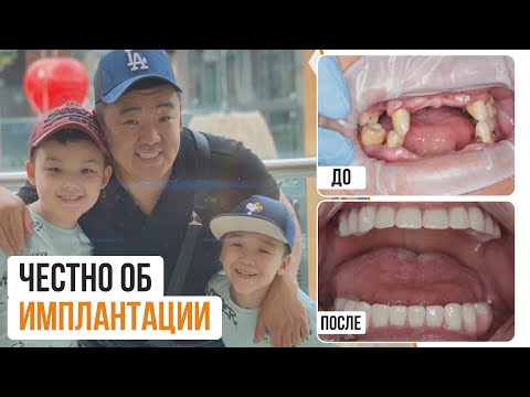 Видео: Зубной протез до/после реальный отзыв 😍 18+