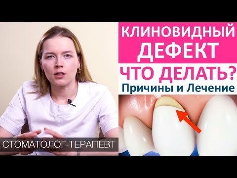 Видео: Клиновидный дефект - причины, симптомы, лечение клиновидного дефекта.