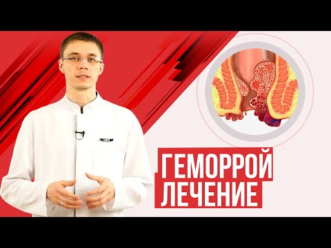 Видео: геморрой лечение, диагностика, полезные советы