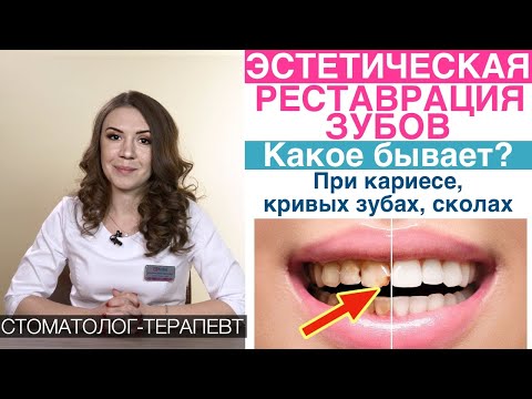 Видео: Эстетическая реставрация передних зубов, композитный (пломбировочный) материал, винирами.Кариес,щель