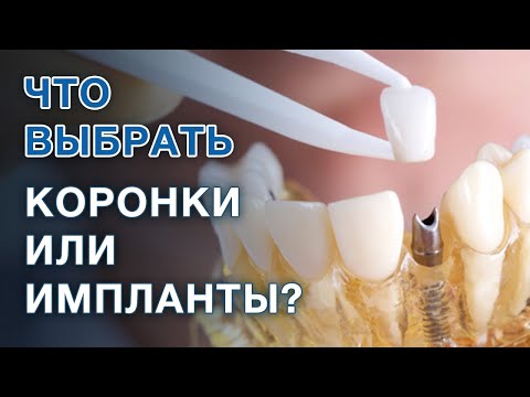 Видео: Коронки или имплант: что лучше выбрать? / Если зуб разрушен, удалять и ставить имплант или коронку?