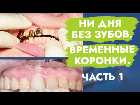 Видео: Ни дня без зубов. Временные коронки. Часть 1.