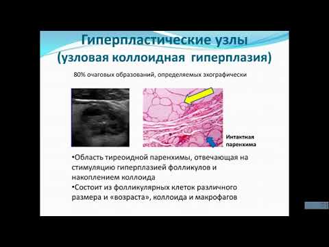 Видео: УЗИ узлов щитовидной железы.Видеолекция