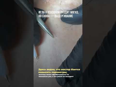 Видео: Разбираем ошибки начинающего мастера электроэпиляции ДО и ПОСЛЕ